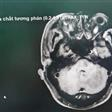 Thanh Hóa: Phẫu thuật thành công ca U não kích thước 3x2cm